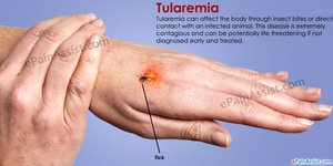 Tularemia lesion on hand from tick bite