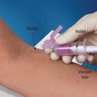 Venipuncture using a vacuum tube system