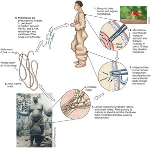Filarial worm life cycle and lymphatic blockage
