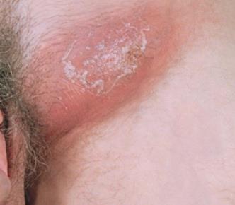 LGV infection of lymph nodes