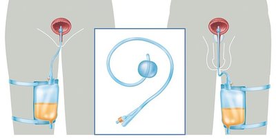 Foley catheter in urinary tract