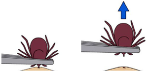 Proper tick removal technique