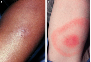 Erythema migrans rash in different skin tones