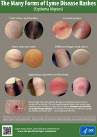 Various forms of Lyme disease rashes (erythema migrans)