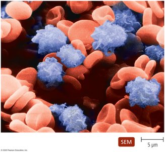 Extensions of the cytoplasmic membrane in hairy cell leukemia