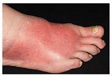 Cellulitis of the foot