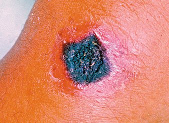 Cutaneous anthrax lesion with black eschar