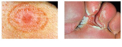 Tinea corporis (body ringworm) and tinea pedis (athlete's foot)