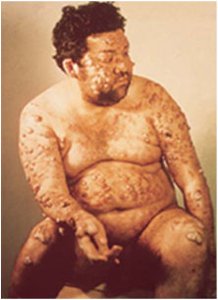 Cutaneous leishmaniasis with ulcerative skin lesion