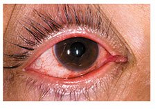 Viral conjunctivitis with red, watery eye