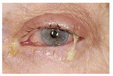Bacterial conjunctivitis with pus-like discharge