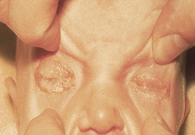 Neonatal conjunctivitis with swollen, red eyes