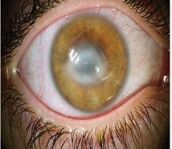 Severe keratitis with corneal opacity