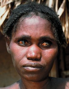 River blindness with eye and facial changes