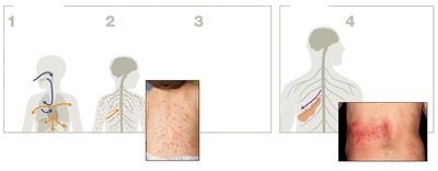 Diagram showing chickenpox and shingles progression and rashes