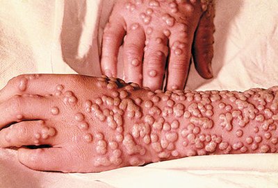Smallpox pustular rash on hands and arms