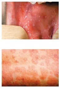 Koplik's spots and measles maculopapular rash