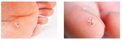 Images of plantar and seed warts on the foot