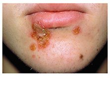 Impetigo lesions around the mouth