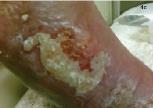 Pacemaker as a site for biofilm formation