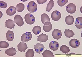 Red blood cells infected with Plasmodium (malaria) ring stage