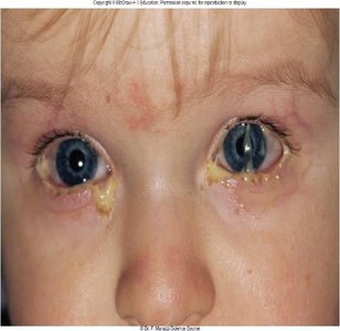 Child with bacterial conjunctivitis (pus in eyes)