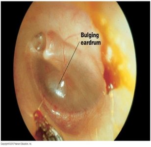 Bulging eardrum in otitis media