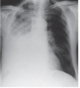 Chest X-ray showing pneumonia