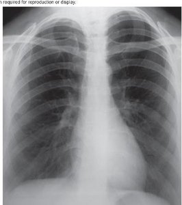 Chest X-ray showing pneumonia with consolidation