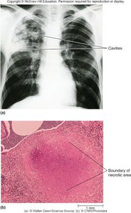 Chest X-ray and histology showing TB cavities and necrotic area