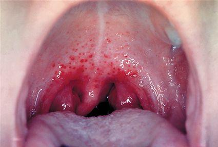Red spots and inflammation in the throat due to strep throat