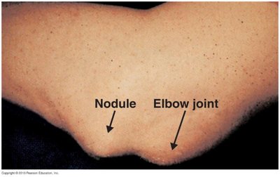 Nodule on elbow joint, a complication of rheumatic fever