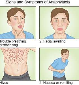 Signs and symptoms of anaphylaxis