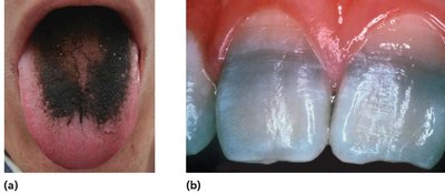 Side effects: black hairy tongue and tooth enamel damage