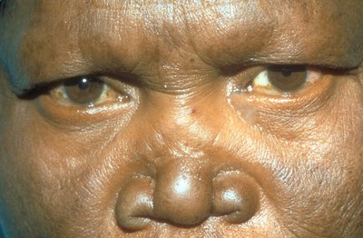 Leprosy facial deformities