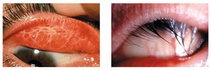 Scarring and inward-turning eyelashes in trachoma