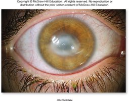 Keratitis with corneal opacity