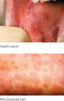Koplik's spots and maculopapular rash in measles