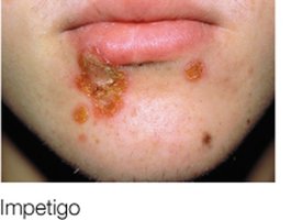 Impetigo lesion on the face