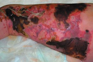 Necrotizing fasciitis with extensive tissue damage