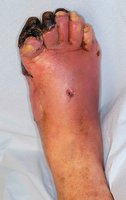 Gas gangrene with tissue necrosis in the foot