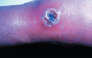Cutaneous anthrax lesion with black eschar