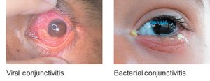 Comparison of viral and bacterial conjunctivitis