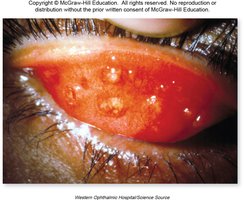 Pebbled appearance of inner eyelid in trachoma