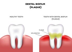 Diagram comparing healthy tooth and tooth with dental biofilm (plaque)