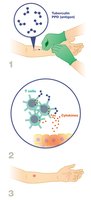 Tuberculin skin test (PPD test) for type IV hypersensitivity