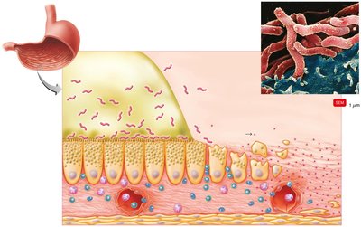 Helicobacter pylori infection and ulcer formation