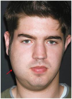 Swelling of parotid gland in mumps