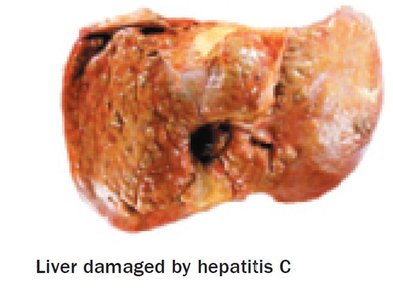 Liver damaged by hepatitis C
