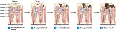 Stages of tooth decay